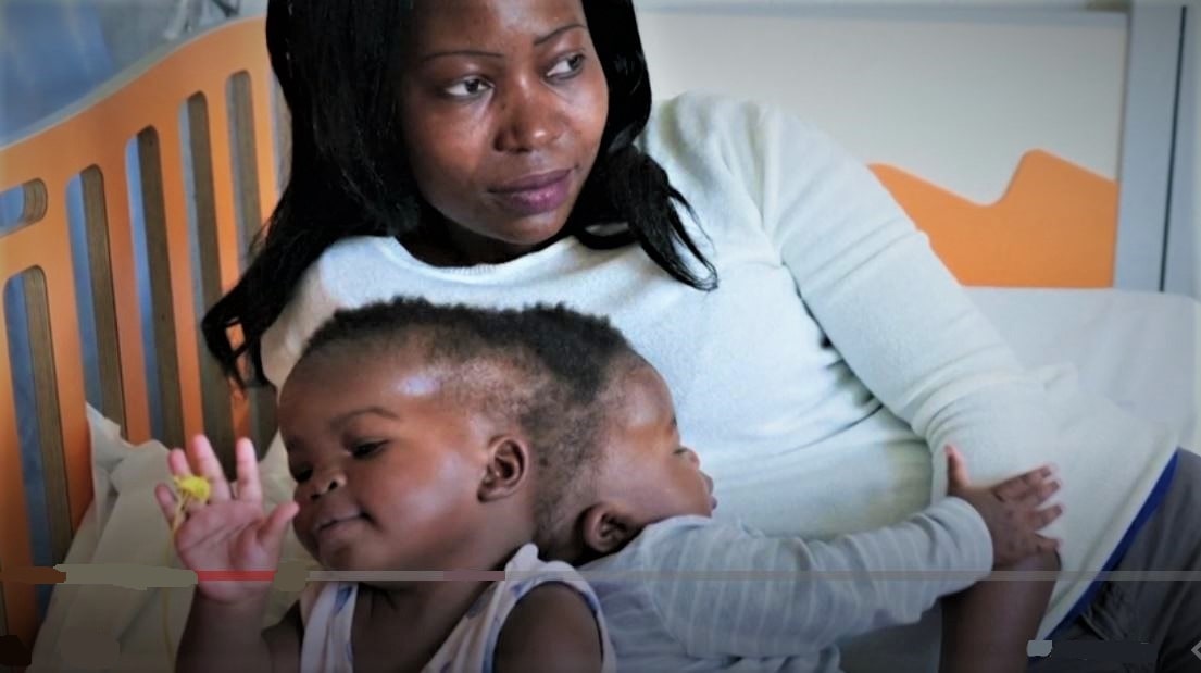 १८ घण्टापछि टाउको छुट्याइयो, बच्चा सकुसल image