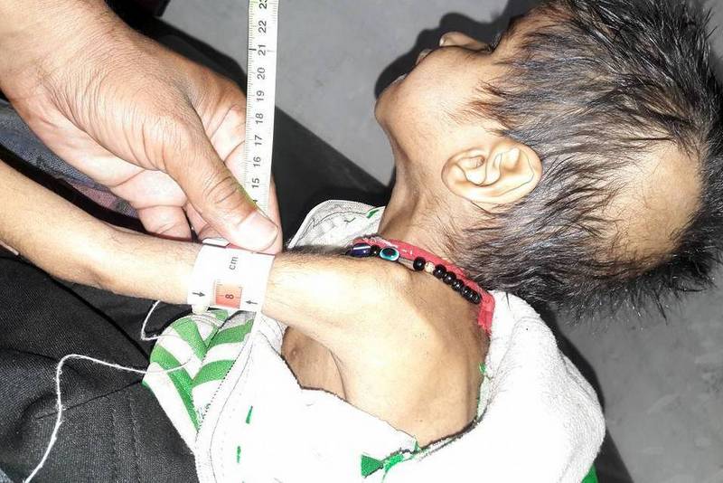 नेपालमा ३२ प्रतिशत बालबालिका दीर्घरुपमा कुपोषित