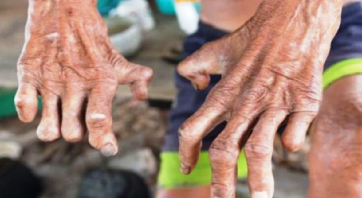 कर्णालीमा घट्दो दरमा कुष्ठरोग image