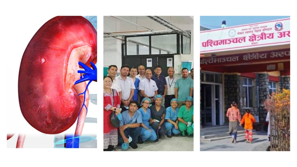 पश्चिमाञ्चल क्षेत्रीय अस्पतालमा पहिलो पटक मिर्गौला प्रत्यारोपण
