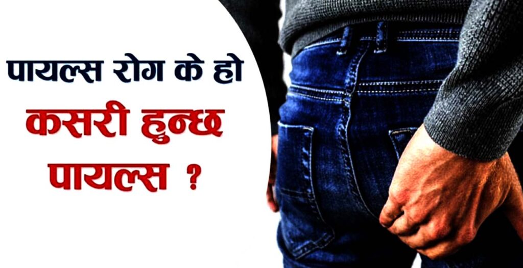 के हो पायल्स ? कसरी गर्ने उपचार ?
