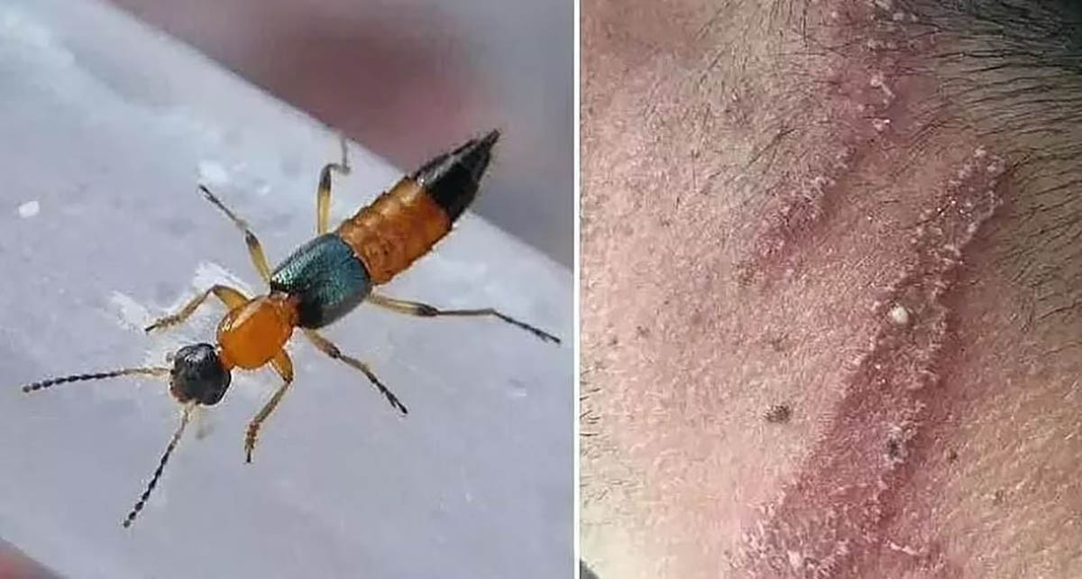 प्रदेश १ मा नाइरोबी फ्लाईका संक्रमित बढ्दै image
