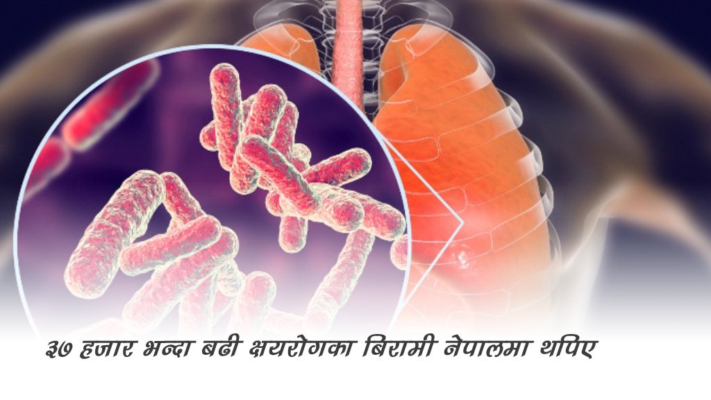 एक वर्षकाे अवधिमा ३७ हजार भन्दा बढी क्षयरोगका बिरामी नेपालमा थपिए