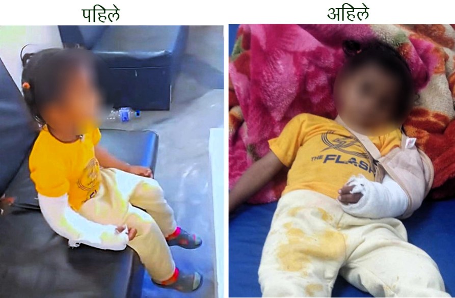 डाक्टरको गम्भिर लापरबाहीः भाँच्चिएको बाँया हात, दाहिनेमा प्लास्टर