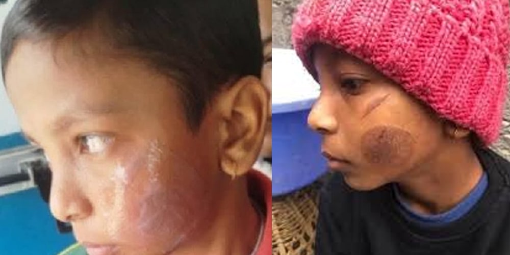 आफूलाई काली भनेको आक्रोशमा विद्यार्थीको गालामा पन्युले डाम्ने शिक्षिका पक्राउ