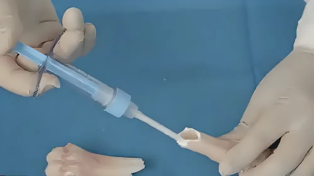 चीनका वैज्ञानिकले बनाए ‘बोन ग्लु’, ३ मिनेटमै भाँच्चिएको हड्डी जोडिने चमत्कारिक प्रविधि