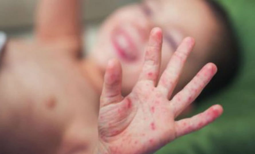 सर्लाहीमा २३ बालबालिकामा दादुरा सङ्क्रमण पुष्टि image